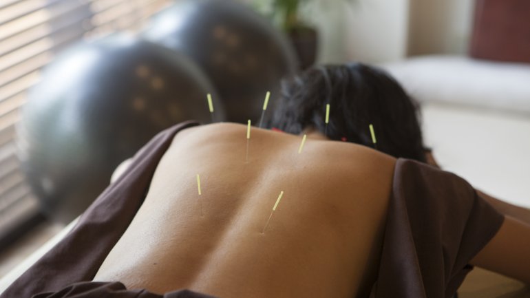 Rücken, gespickt mit Akupunktur Nadeln